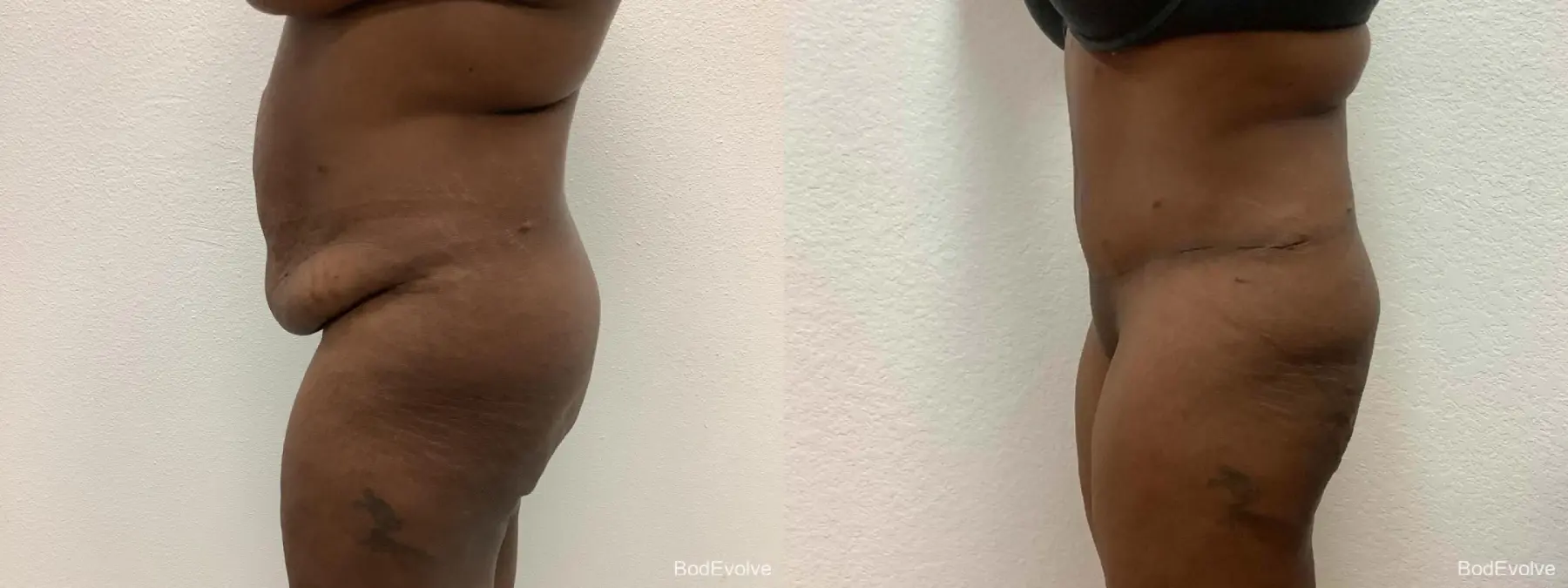 After Massive Weight Loss: Patient 5 - Before and After 3