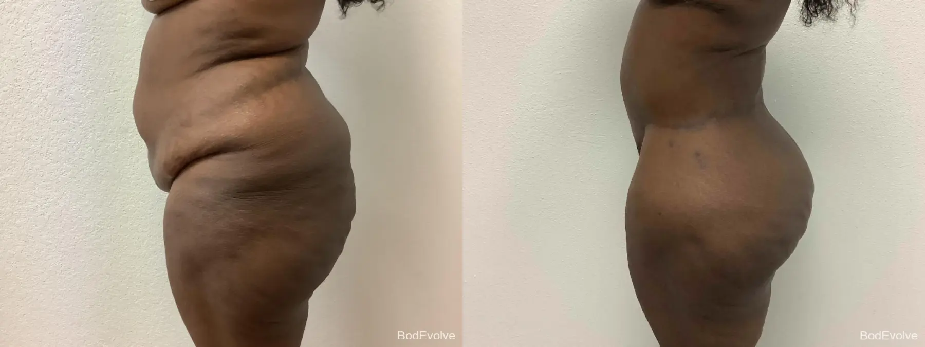 After Massive Weight Loss: Patient 2 - Before and After 3