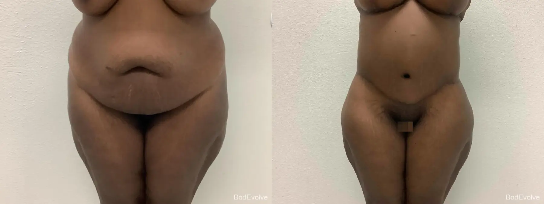 After Massive Weight Loss: Patient 2 - Before and After 1