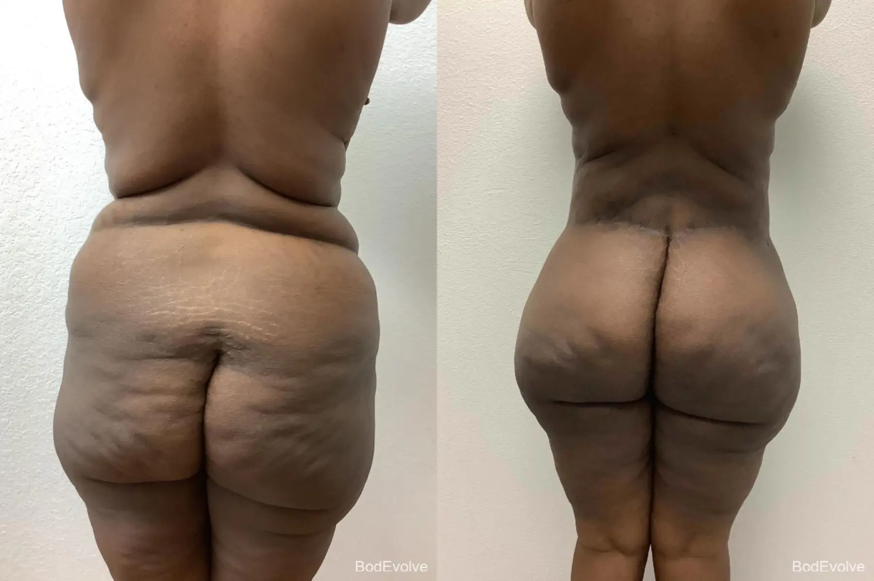 After Massive Weight Loss: Patient 2 - Before and After 4