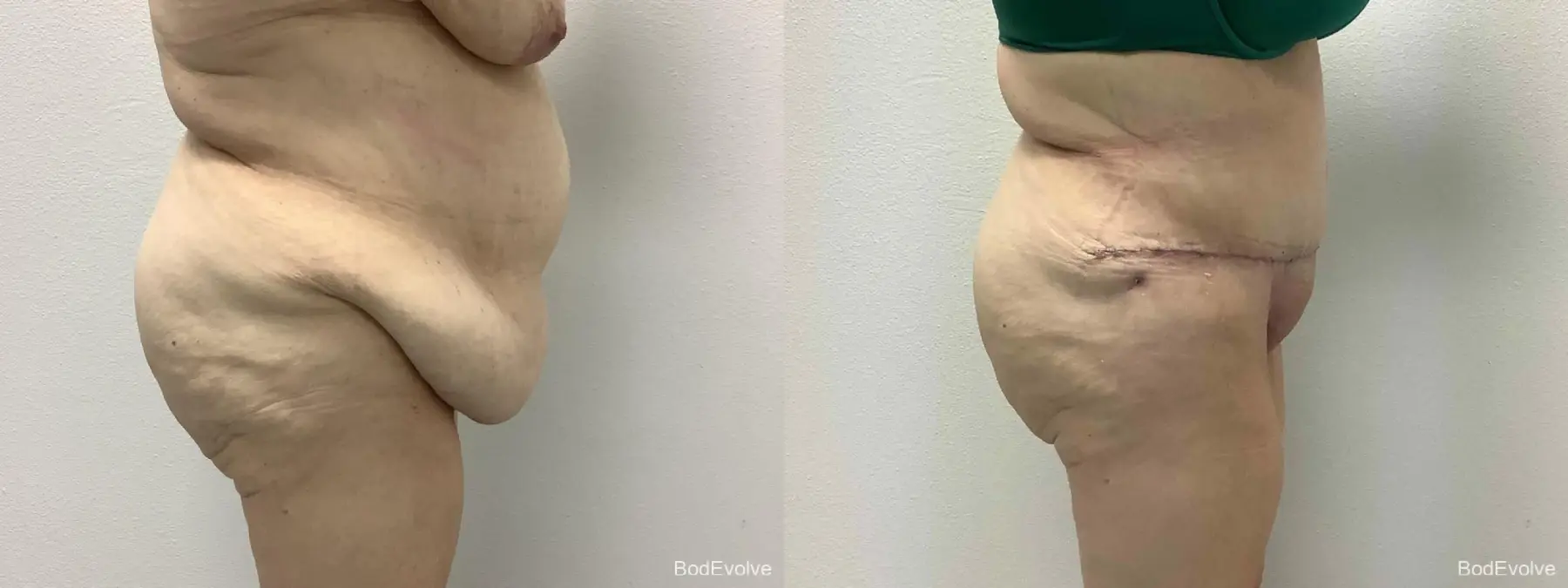 After Massive Weight Loss: Patient 3 - Before and After 5