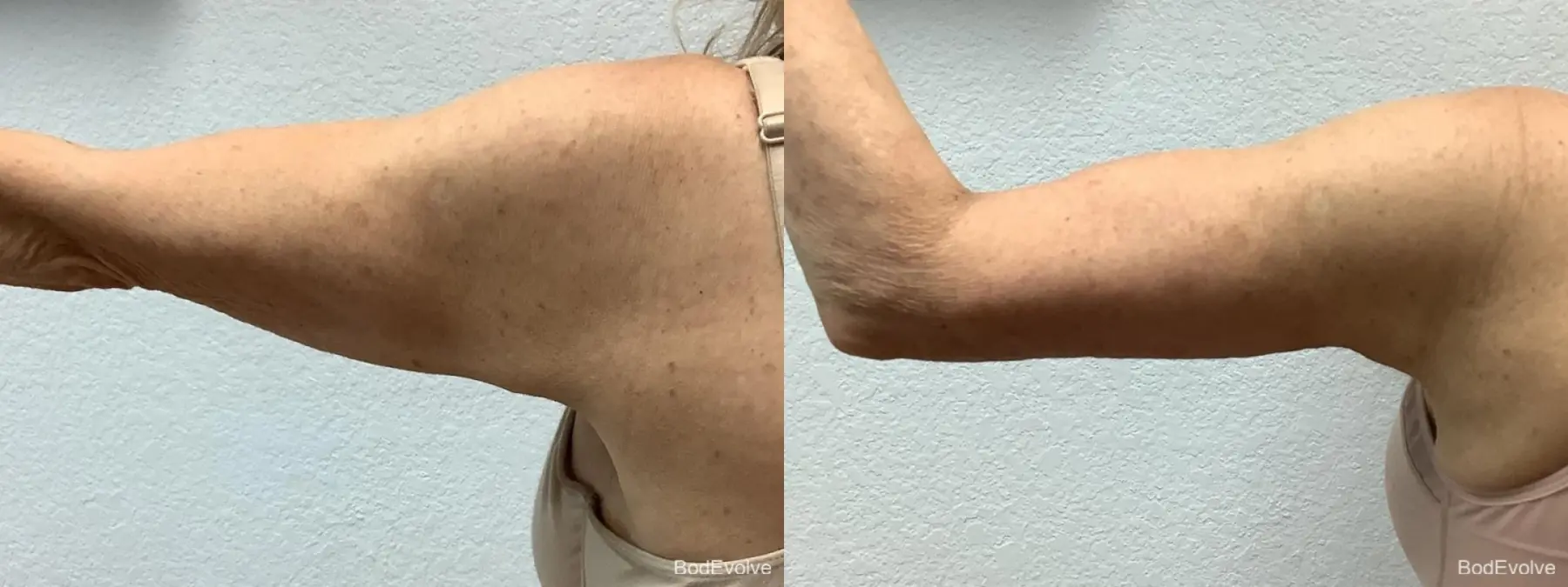 Arm Lift: Patient 4 - Before and After 5