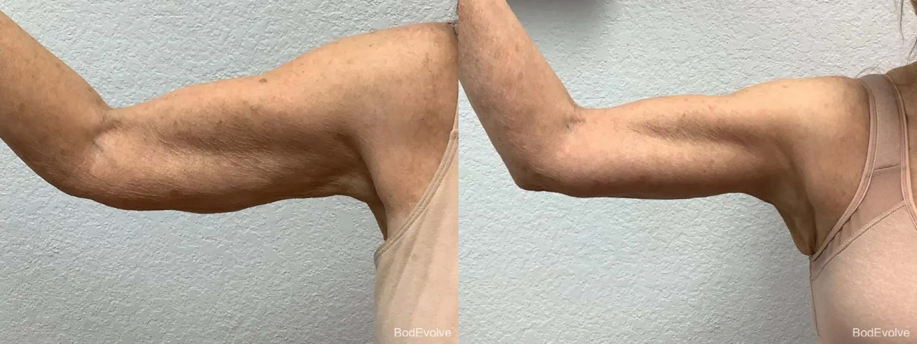 Arm Lift: Patient 4 - Before and After 3