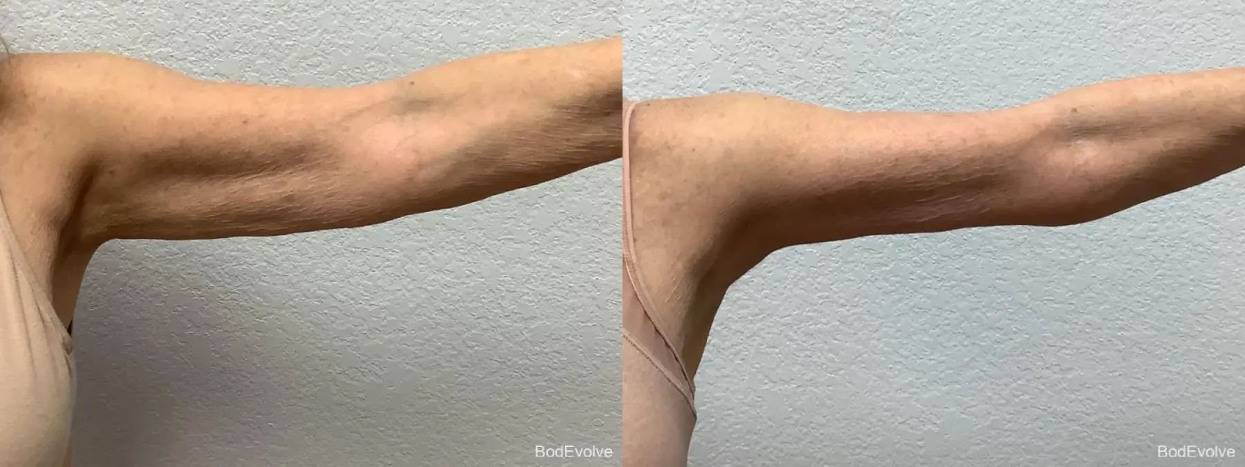 Arm Lift: Patient 4 - Before and After 2