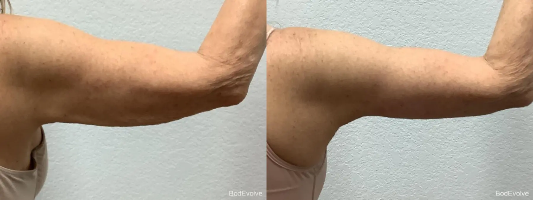 Arm Lift: Patient 4 - Before and After 6