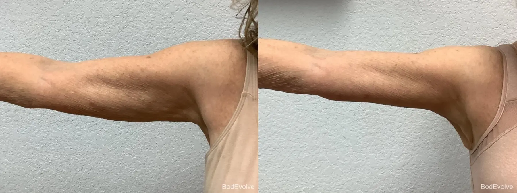 Arm Lift: Patient 4 - Before and After 4