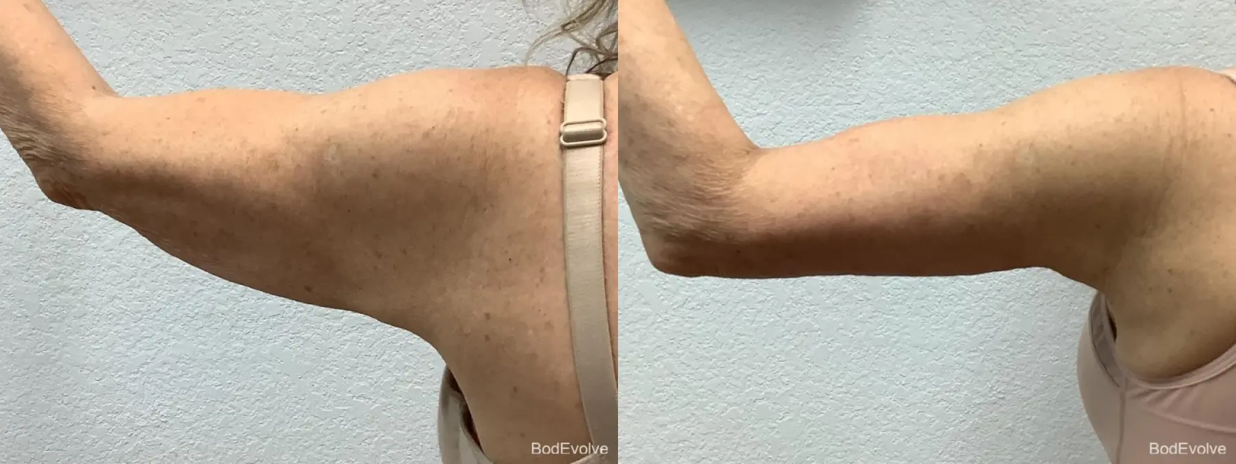 Arm Lift: Patient 4 - Before and After 7