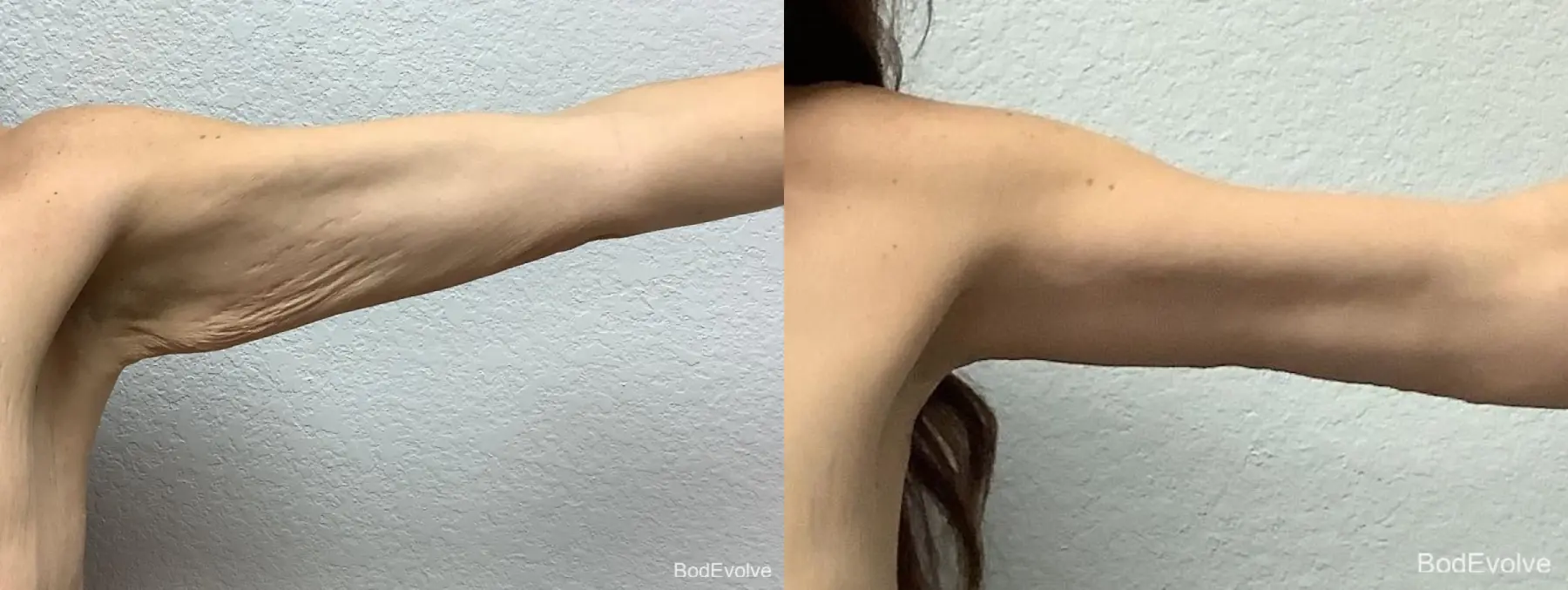 Arm Lift: Patient 8 - Before and After  