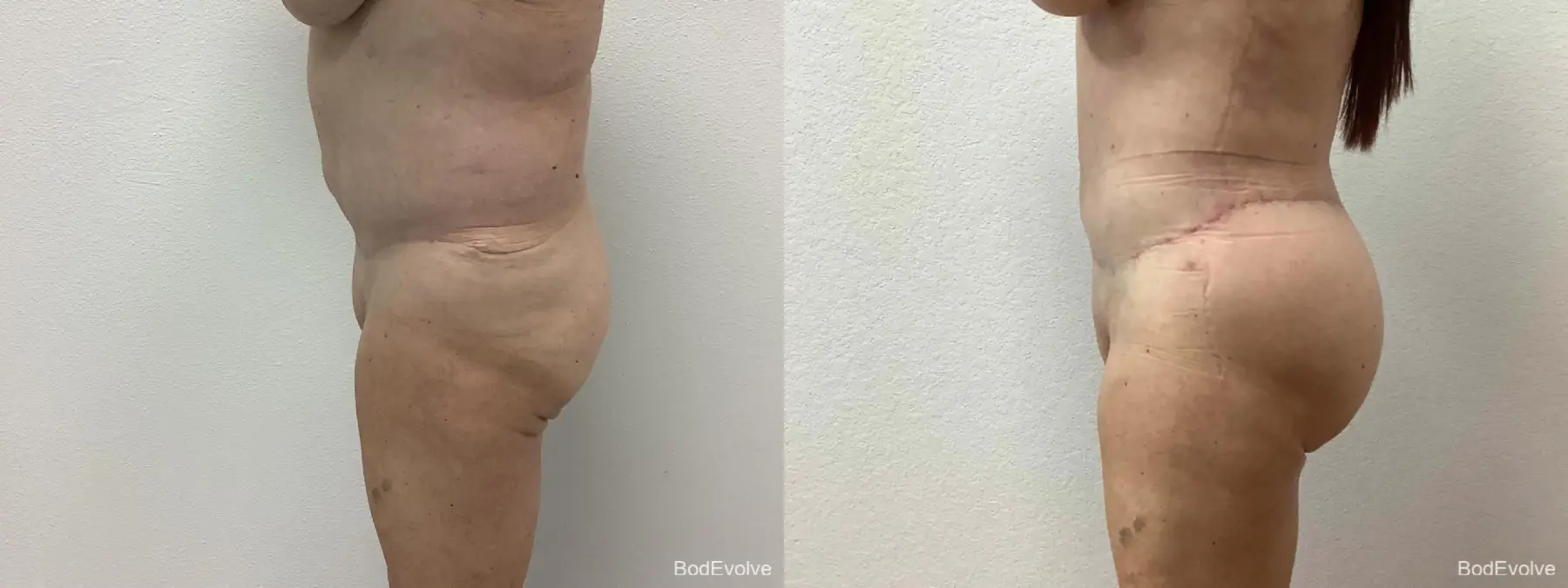 Back Lift: Patient 2 - Before and After 5