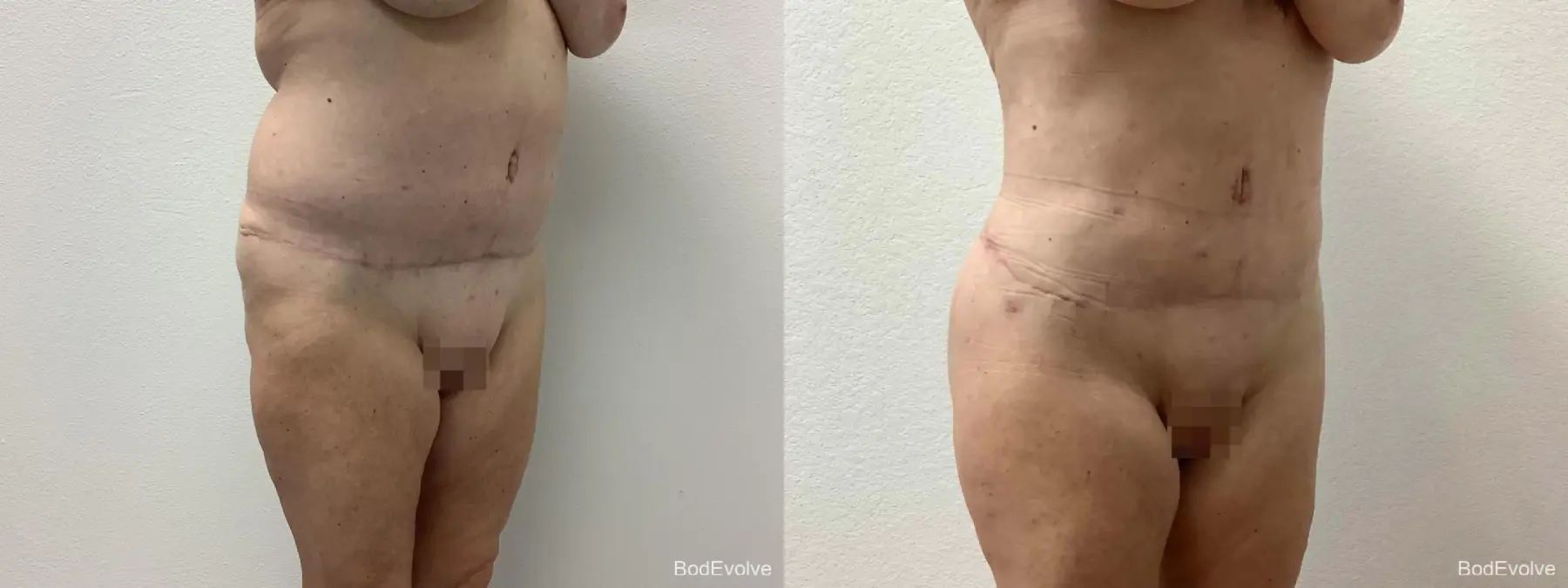 Back Lift: Patient 2 - Before and After 2