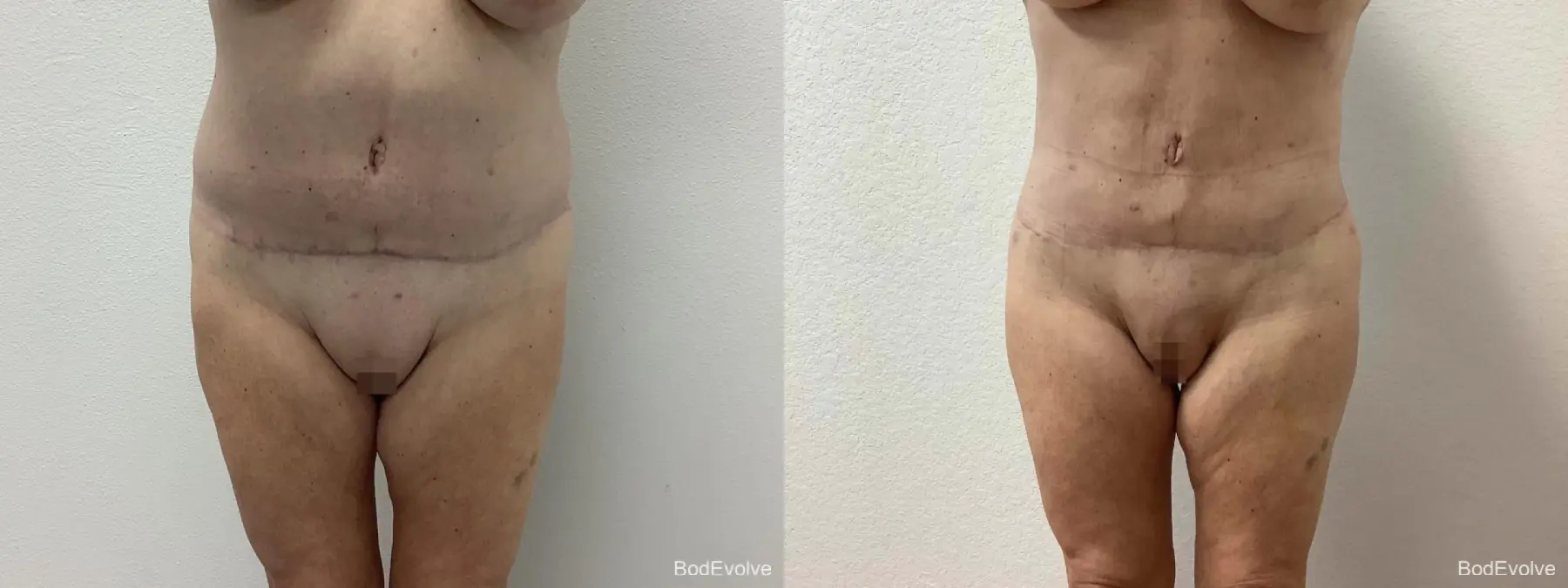 Back Lift: Patient 2 - Before and After 6