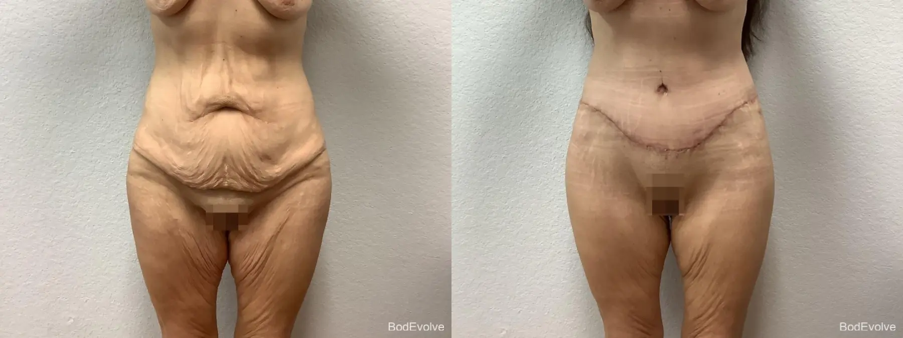 Body Lift: Patient 4 - Before and After  