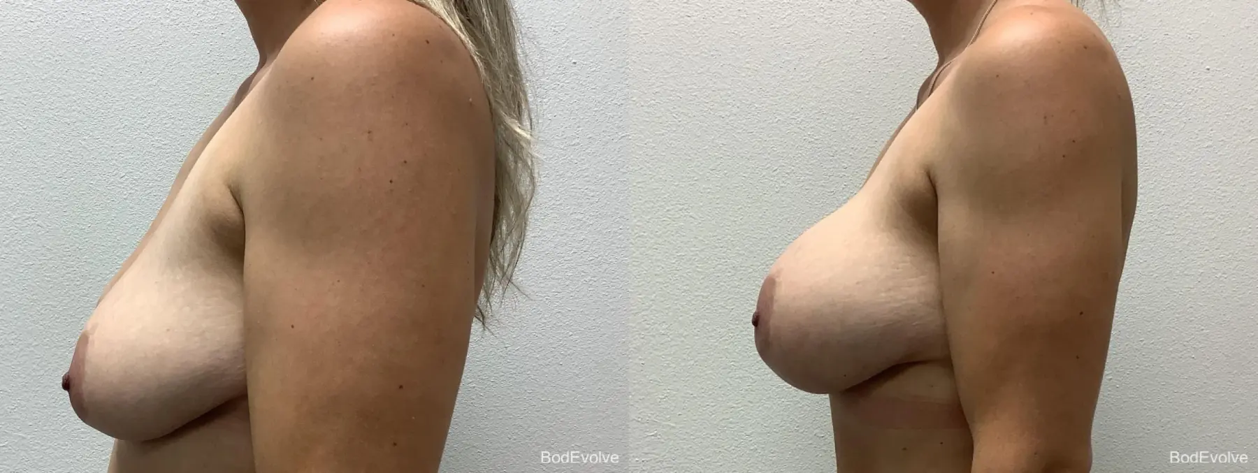 Breast Augmentation: Patient 5 - Before and After 3