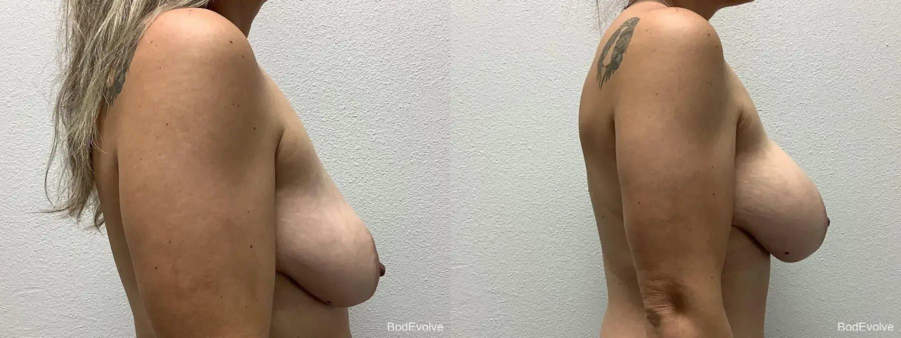 Breast Augmentation: Patient 5 - Before and After 5