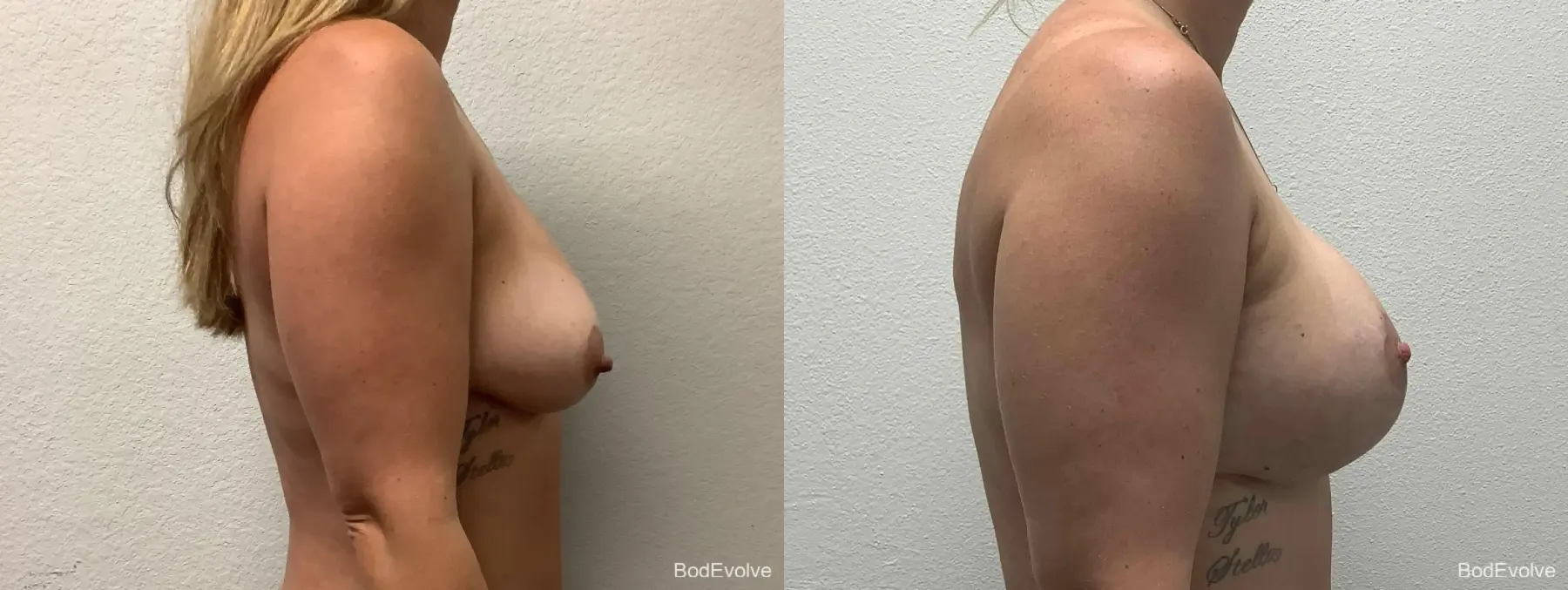 Breast Augmentation With Lift: Patient 2 - Before and After 5