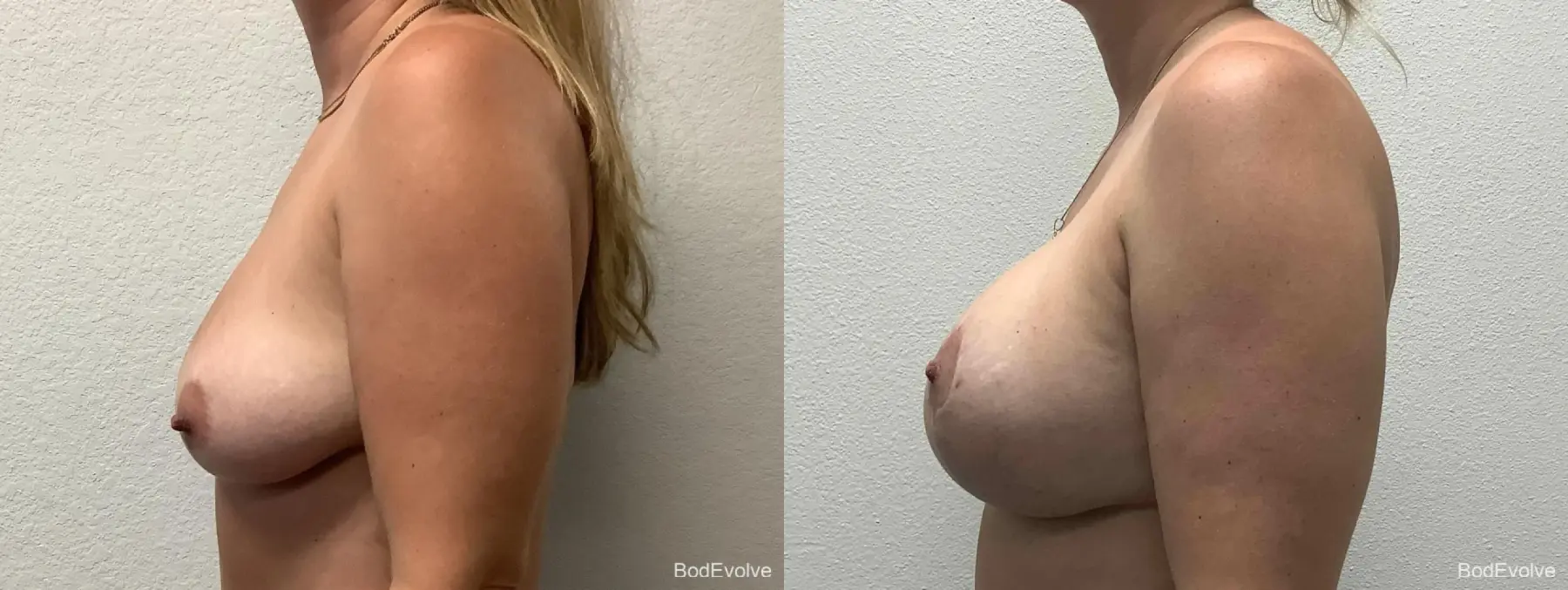 Breast Augmentation With Lift: Patient 2 - Before and After 3