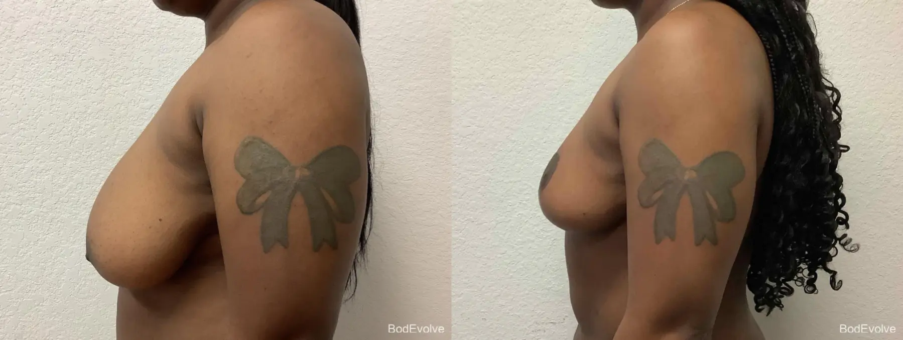 Breast Reduction: Patient 1 - Before and After 3