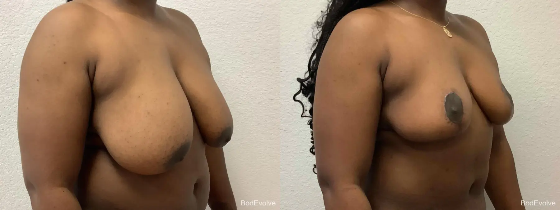 Breast Reduction: Patient 1 - Before and After 4