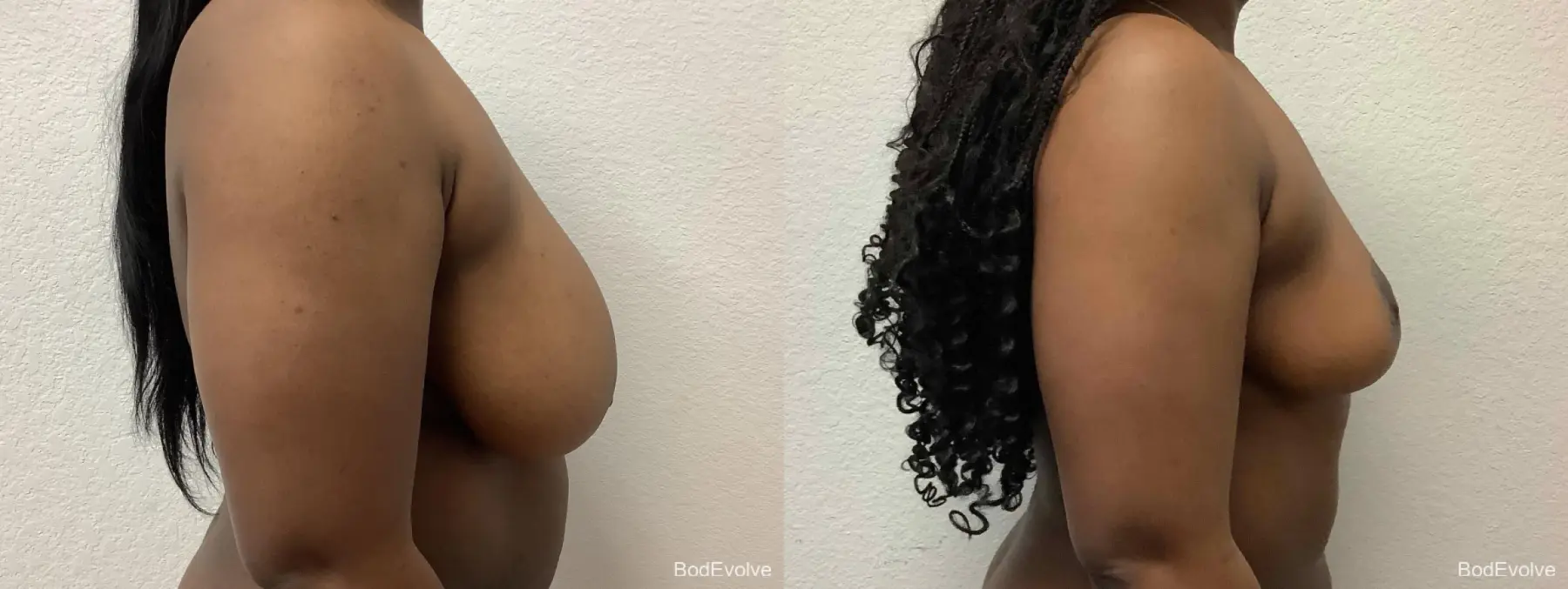 Breast Reduction: Patient 1 - Before and After 5