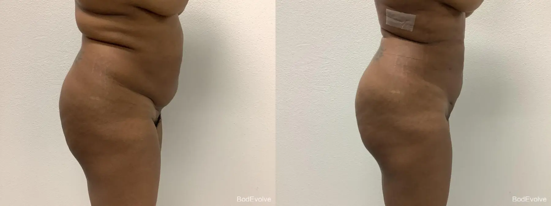 Liposuction: Patient 2 - Before and After 5