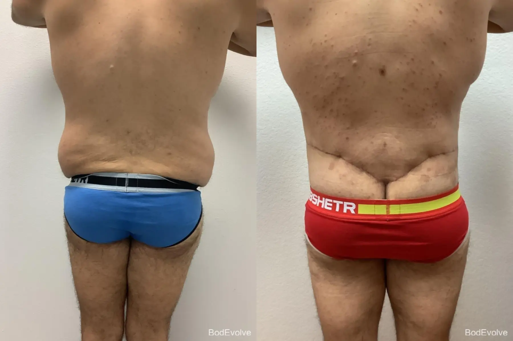 Male Bodylift: Patient 2 - Before and After 6