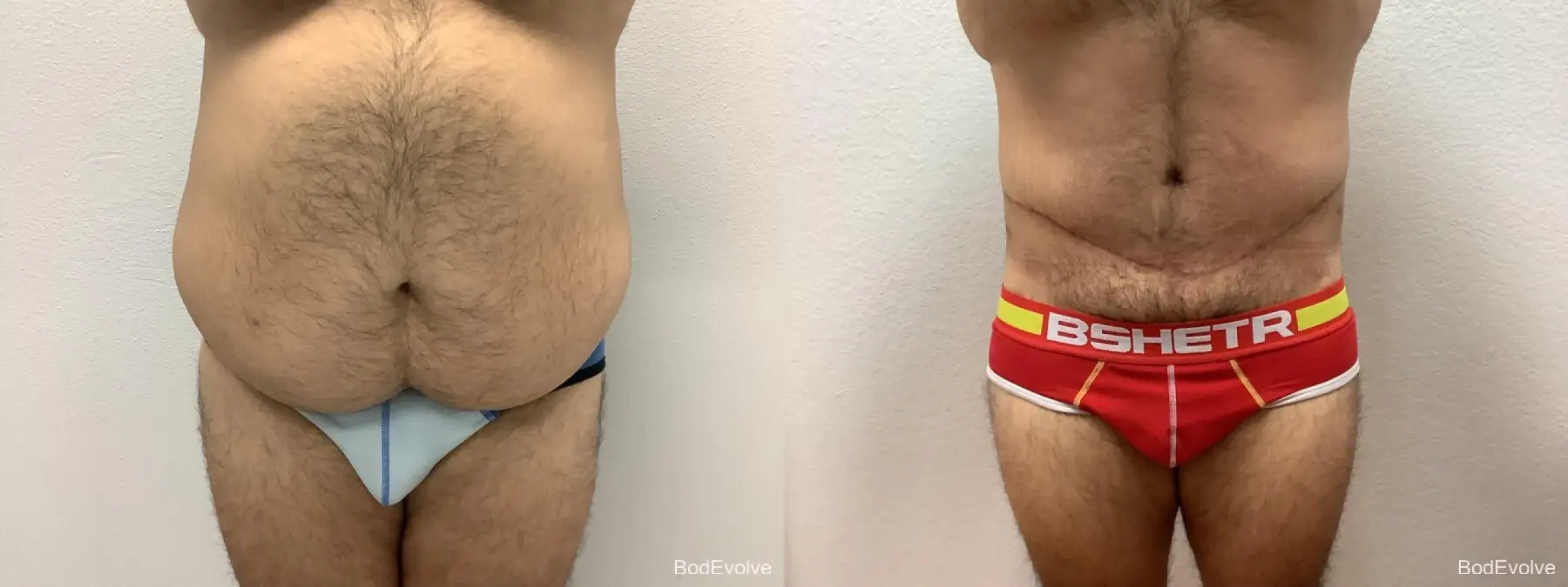 Male Bodylift: Patient 2 - Before and After  
