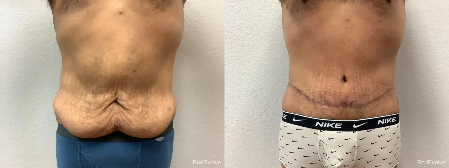 Male Bodylift: Patient 1 - Before and After  
