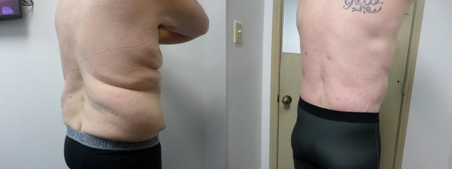 Male Bodylift: Patient 5 - Before and After 7