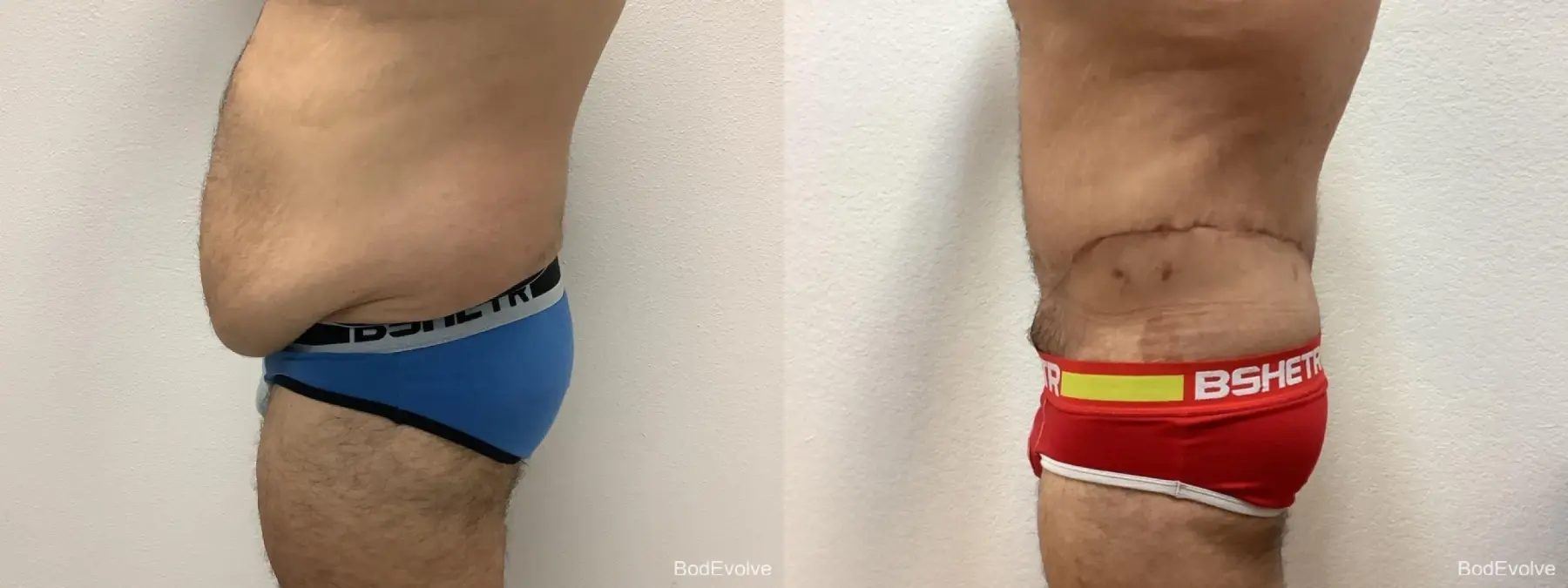 Male Bodylift: Patient 2 - Before and After 3