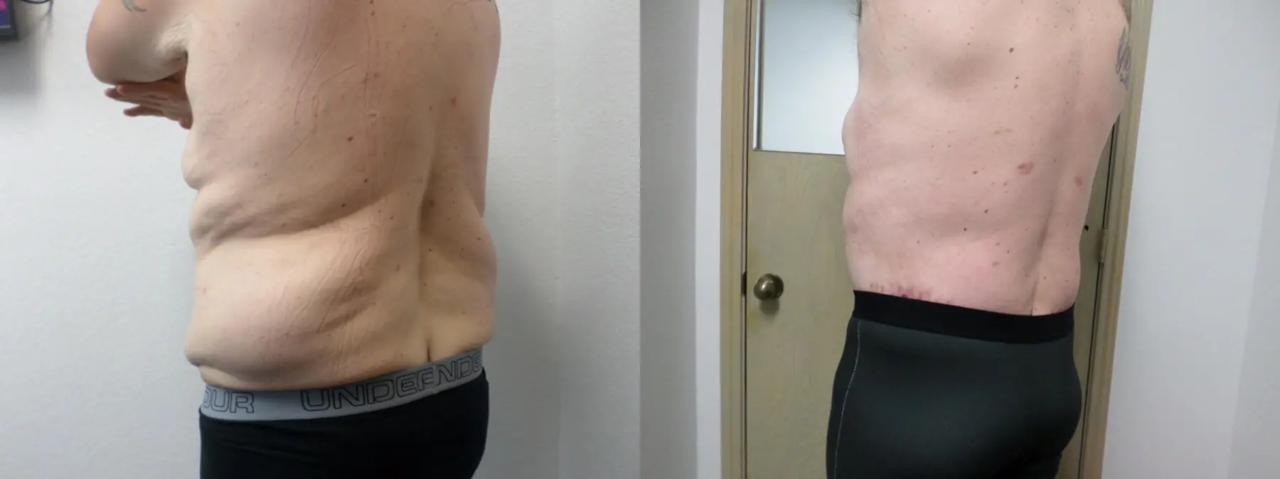 Male Bodylift: Patient 5 - Before and After 6