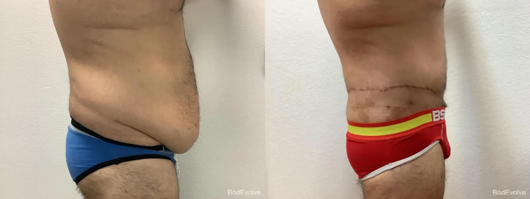 Male Bodylift: Patient 2 - Before and After 5