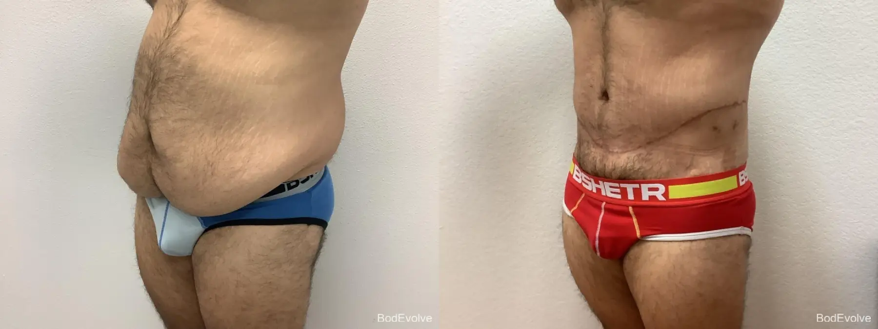 Male Bodylift: Patient 2 - Before and After 2