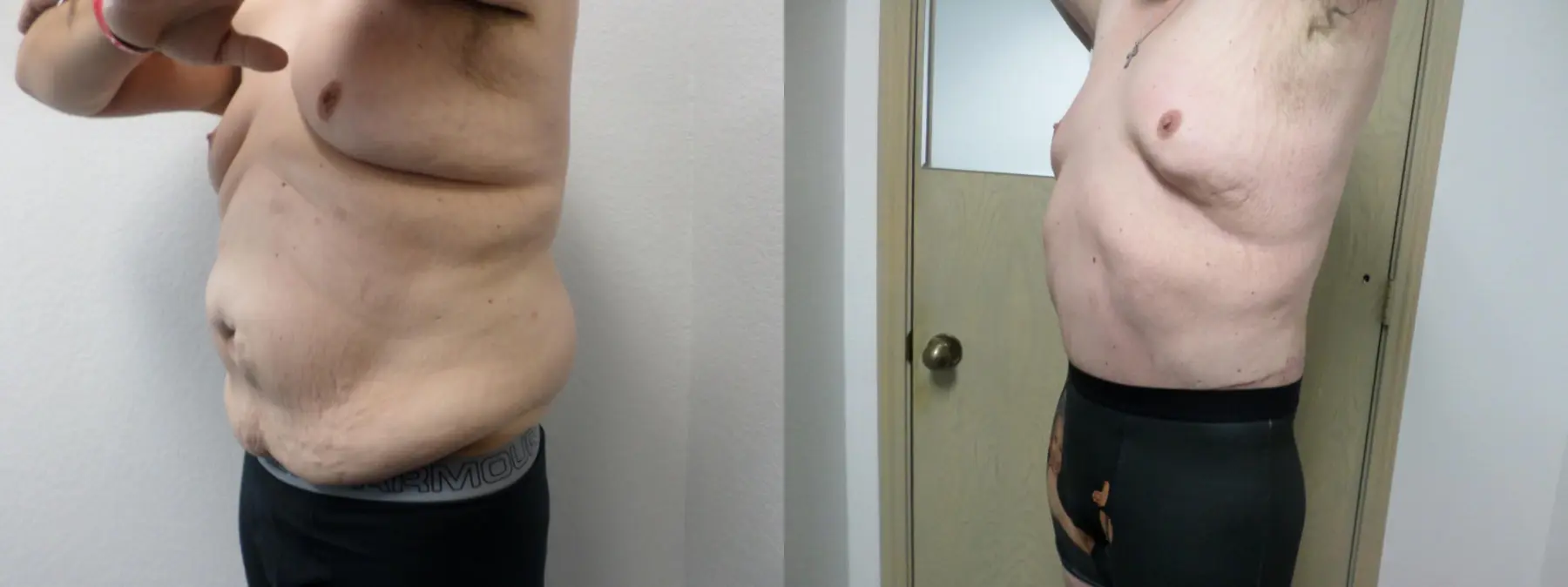 Male Bodylift: Patient 5 - Before and After 2