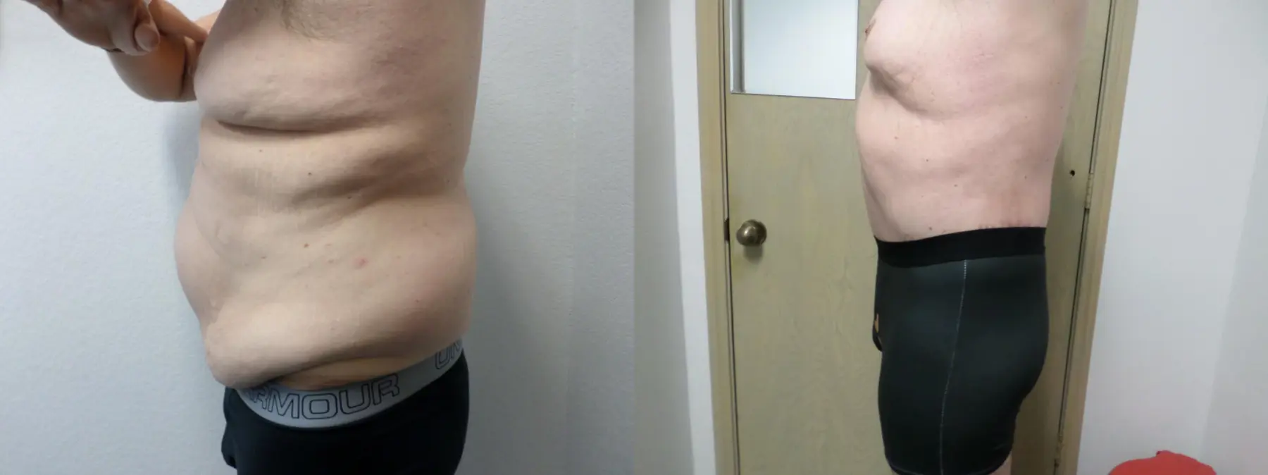 Male Bodylift: Patient 5 - Before and After 3