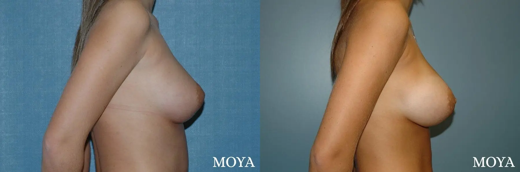 Breast Asymmetry: Patient 1 - Before and After 2