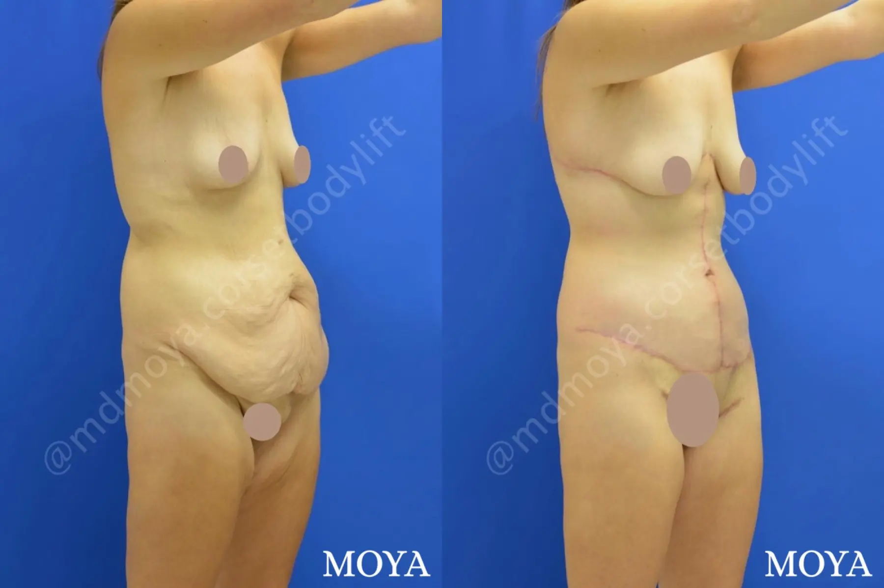 Corset Body Lift® (std):  BMI 23 - Before and After 2