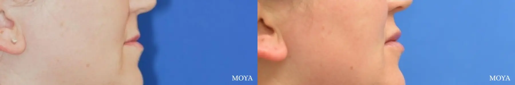 Fillers: Patient 1 - Before and After 2