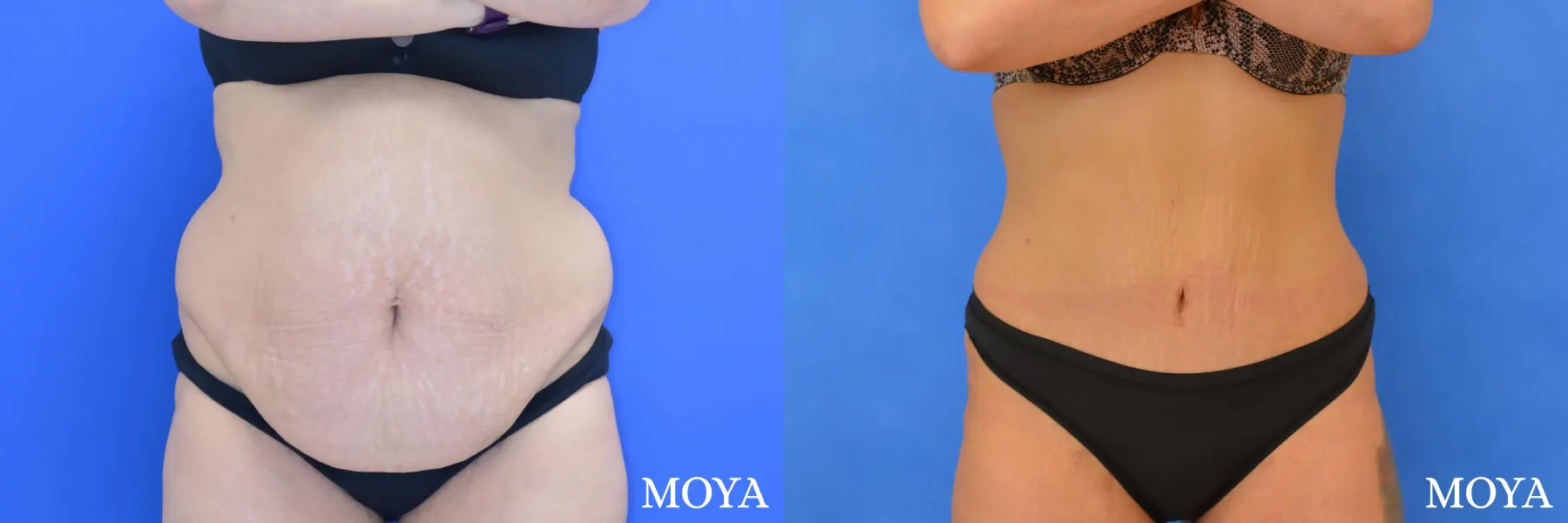 Tummy Tuck (standard) - Before and After 2