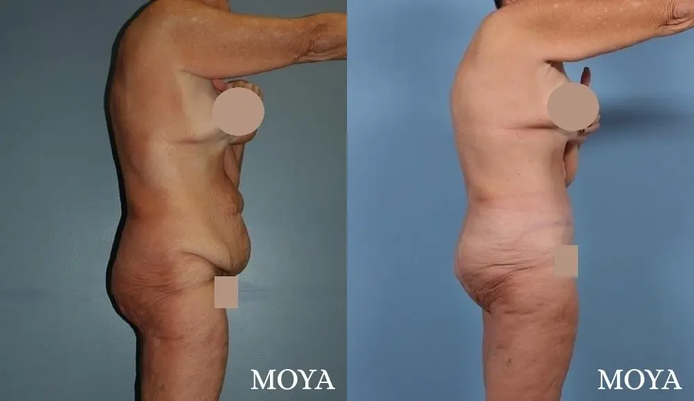 Tummy Tuck (Fleur De Lis) - Before and After 2