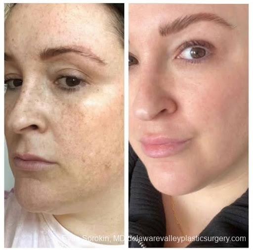 Moxi Laser Resurfacing: Patient 1 - Before and After 1