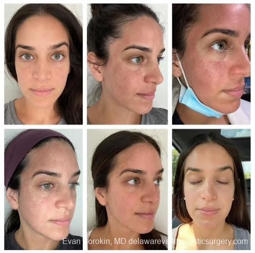 Moxi Laser Resurfacing: Patient 2 - Before and After  