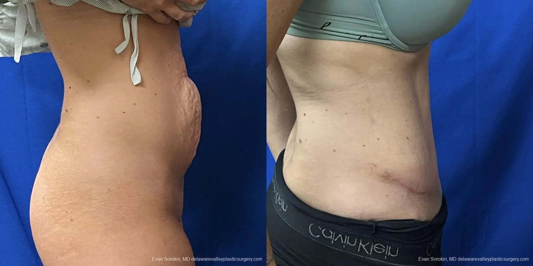 Abdominoplasty: Patient 41 - Before and After 3