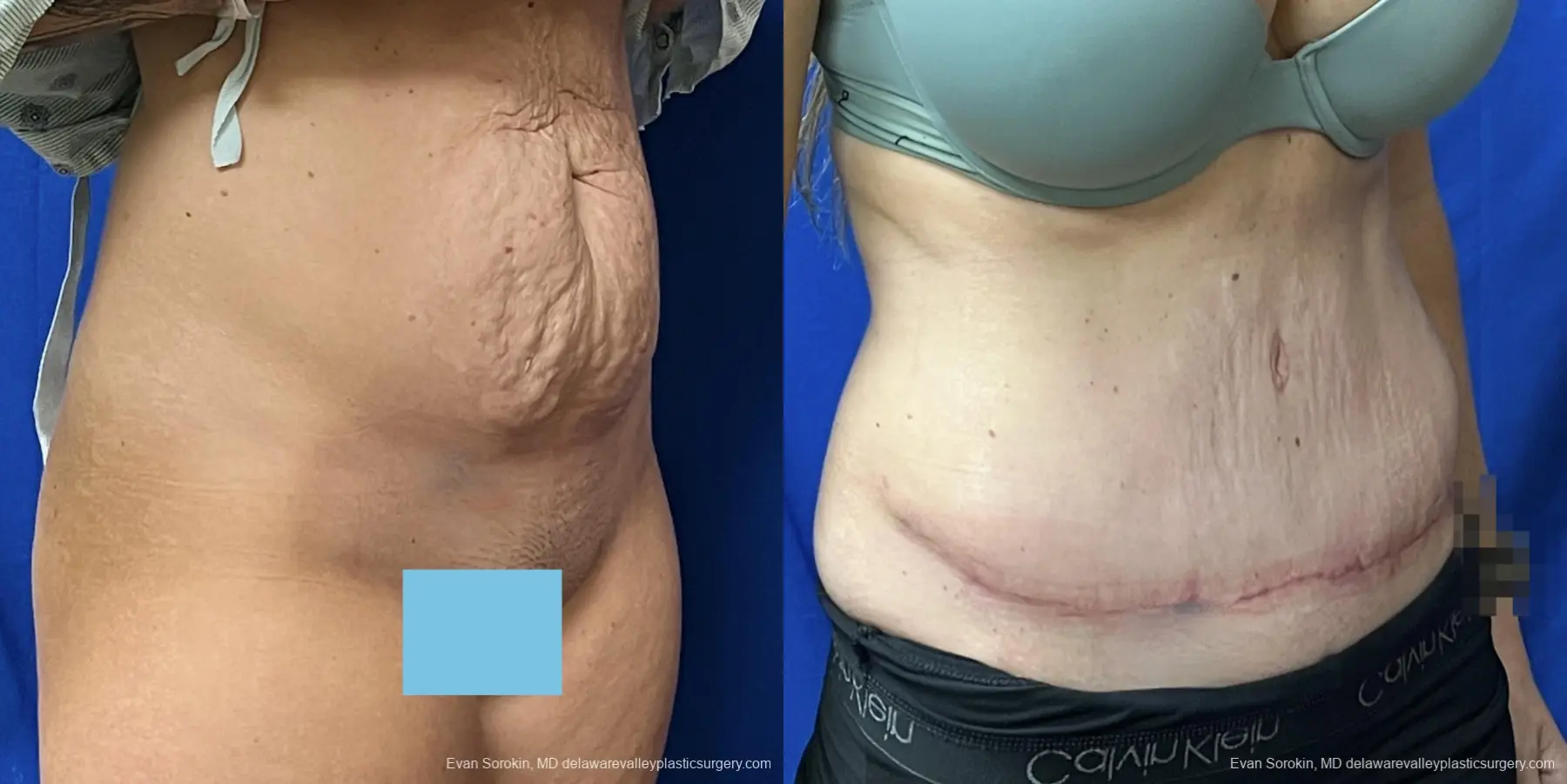 Abdominoplasty: Patient 41 - Before and After 2