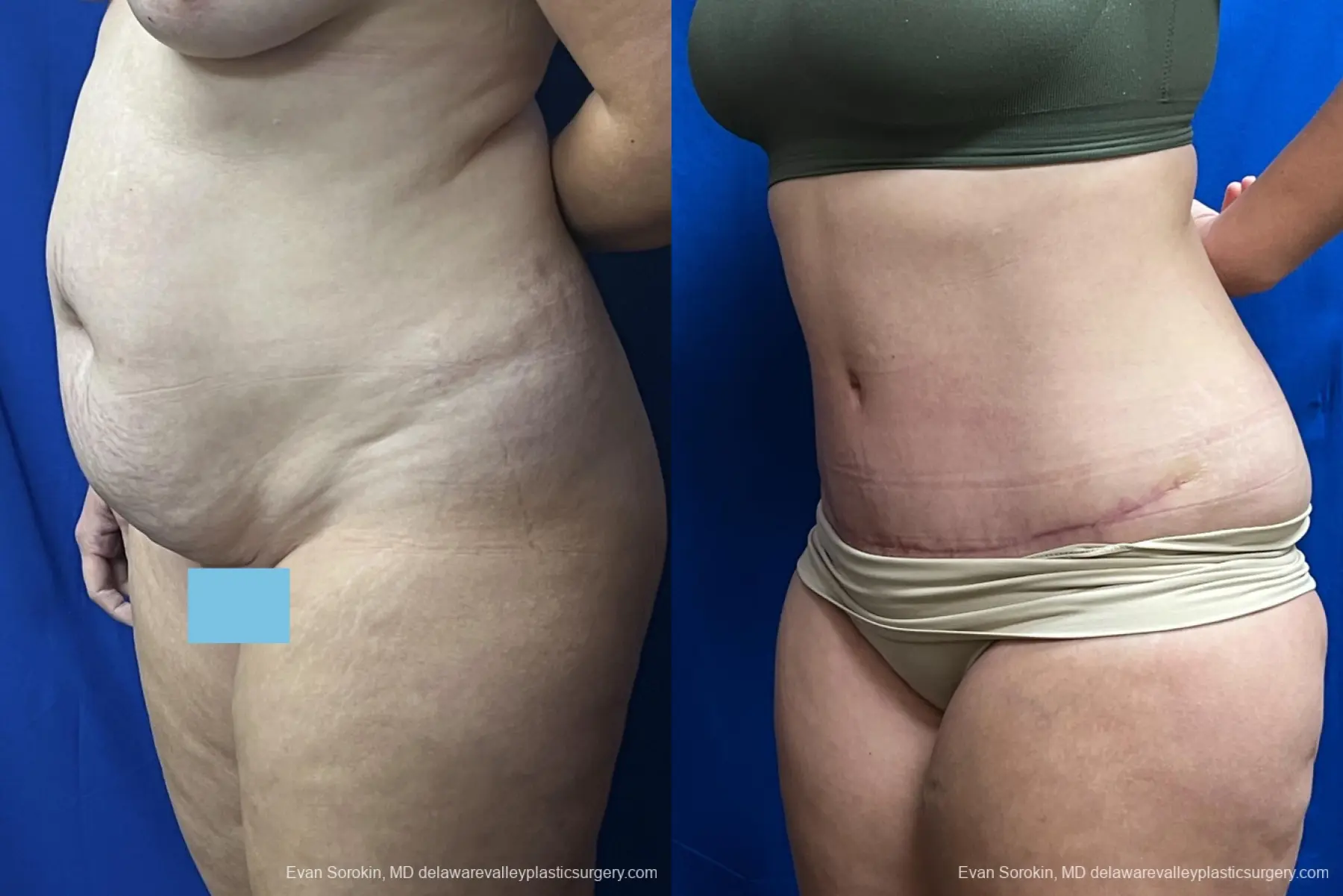 Abdominoplasty: Patient 40 - Before and After 2