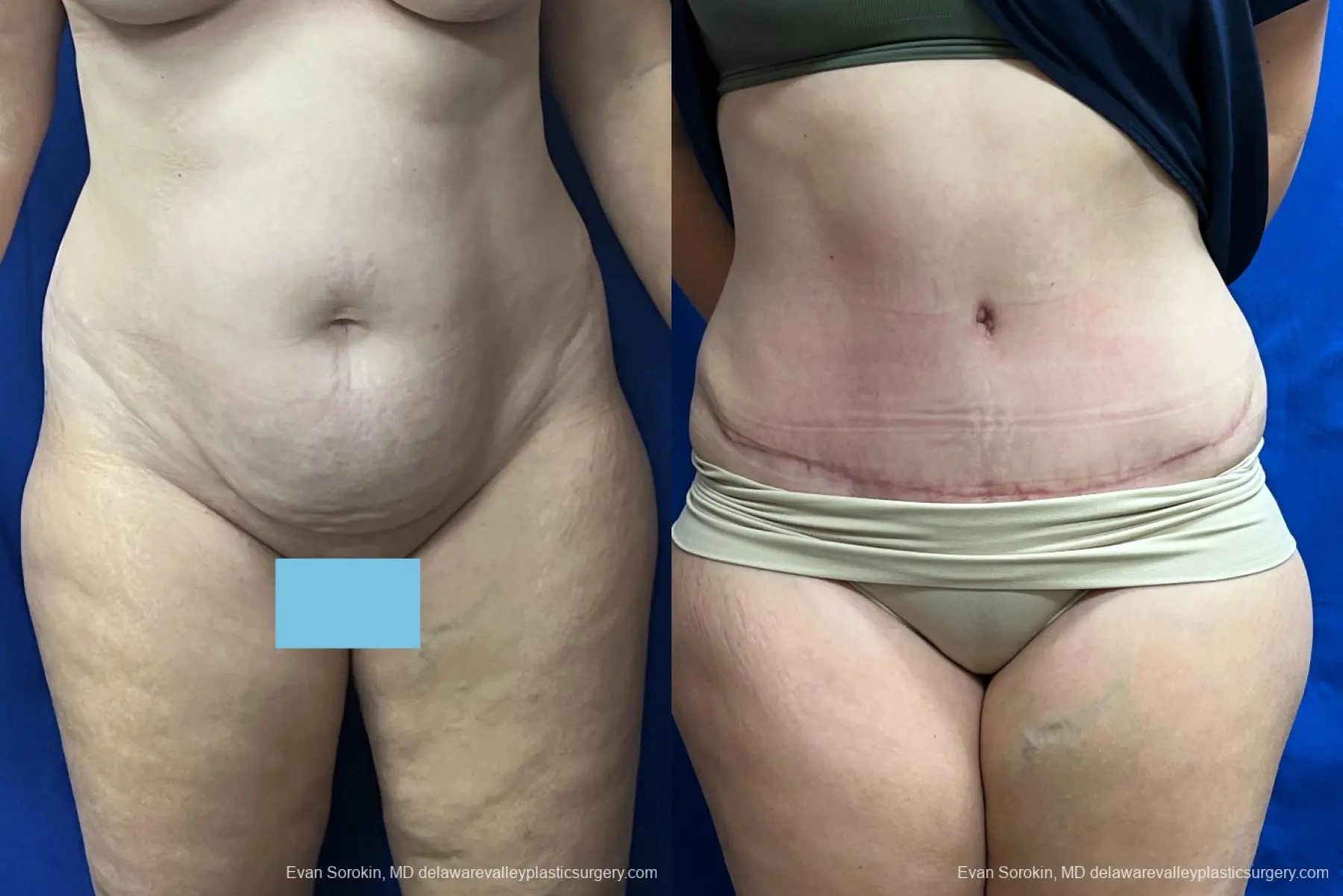 Abdominoplasty: Patient 40 - Before and After 1