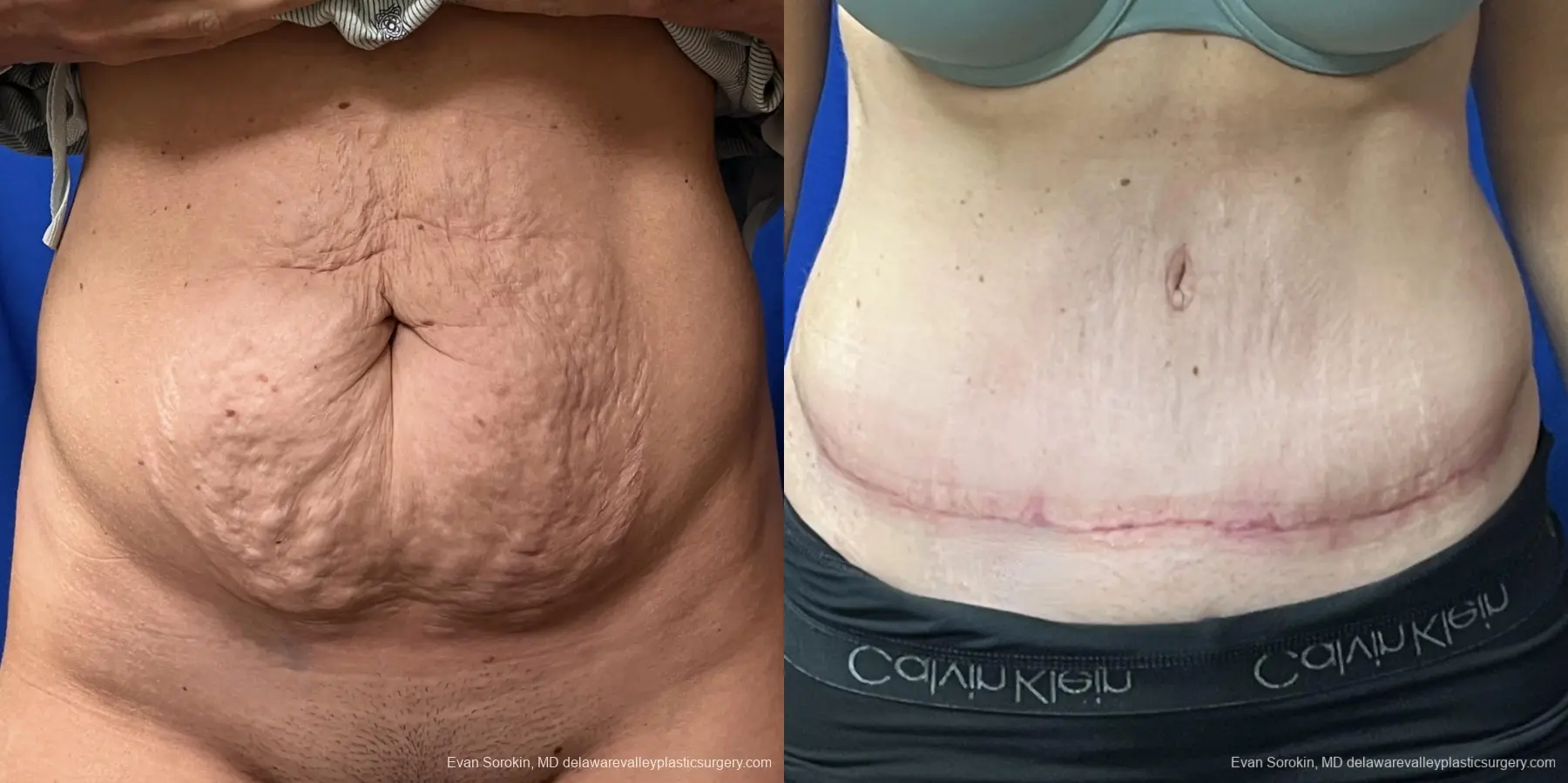 Abdominoplasty: Patient 41 - Before and After 1