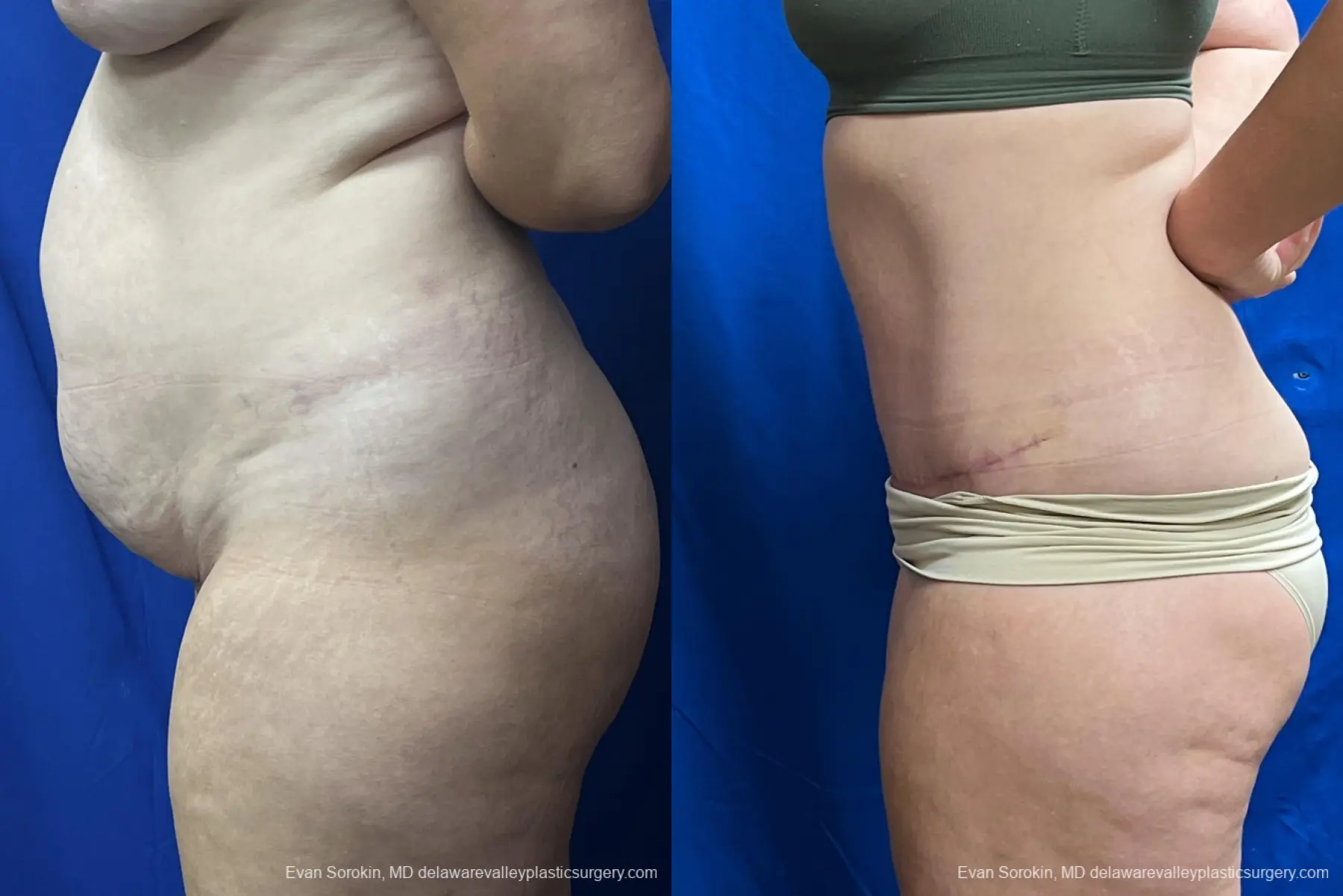 Abdominoplasty: Patient 40 - Before and After 3