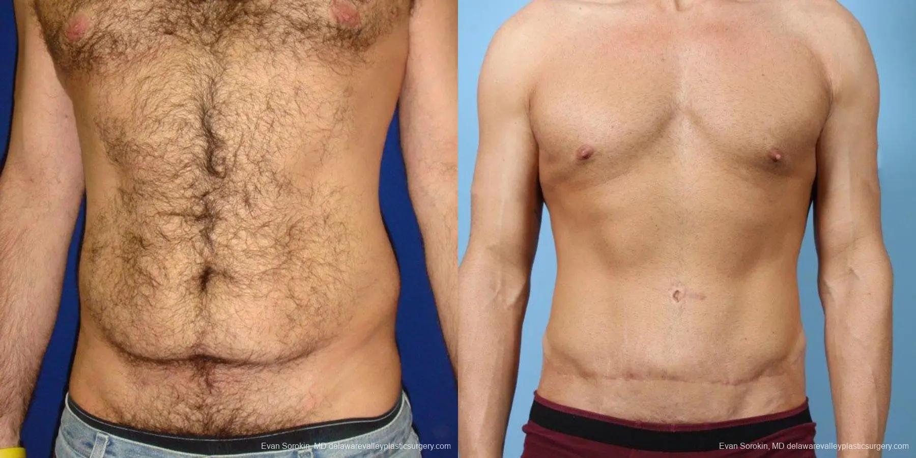 Patient #6023 Male Tummy Tuck (abdominoplasty) Before and After