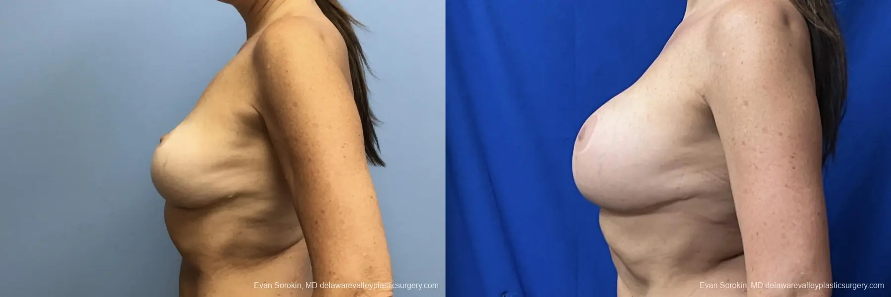 Breast Augmentation: Patient 275 - Before and After 5