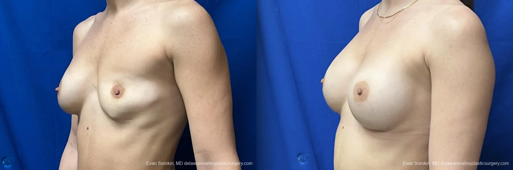 Breast Augmentation: Patient 273 - Before and After 2